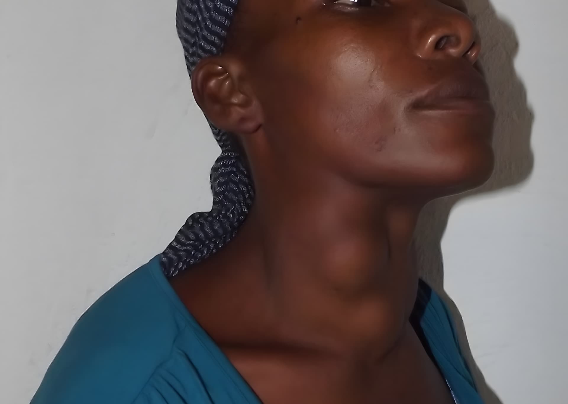 Mimose Before Surgery