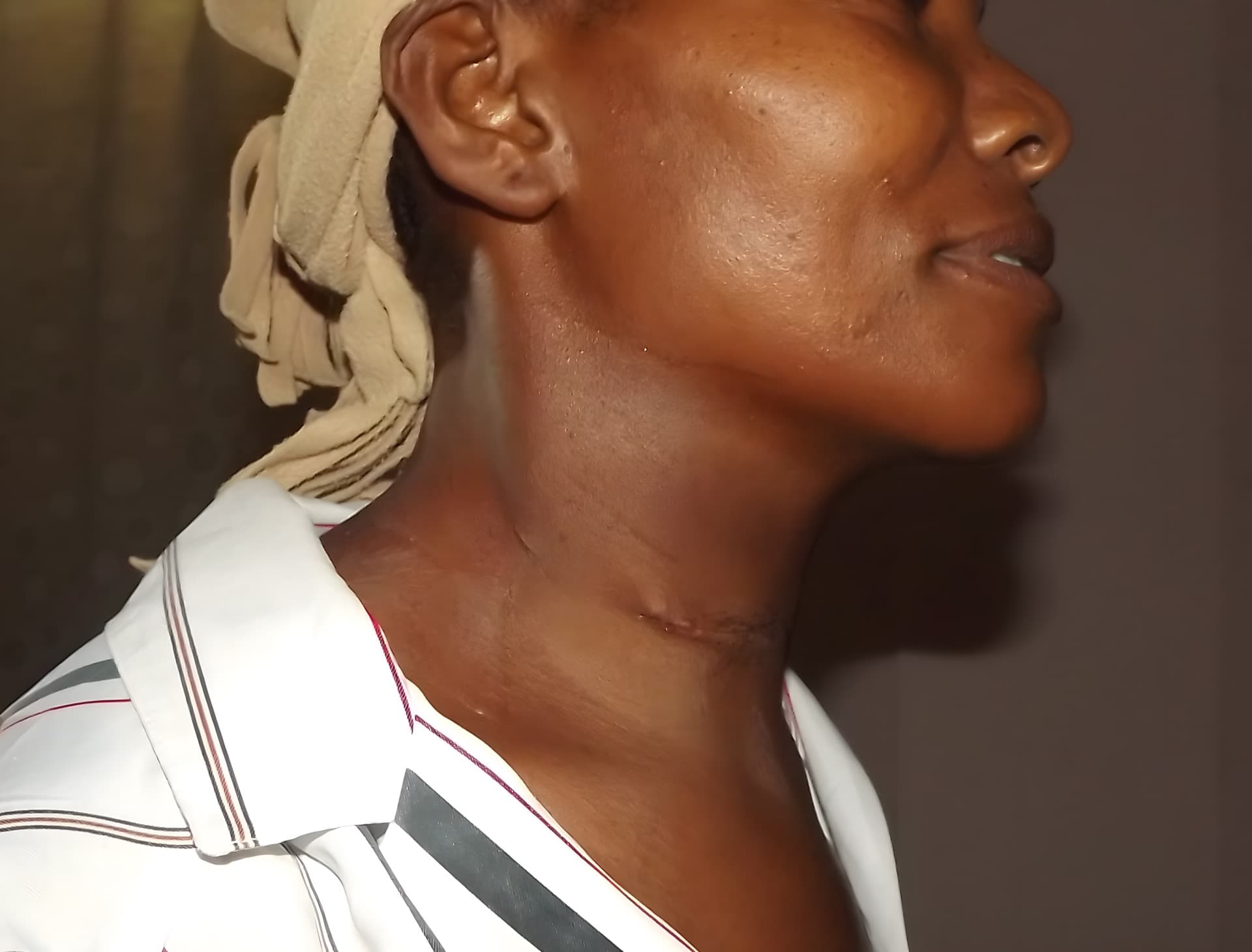 Mimose Two Days Post Surgery